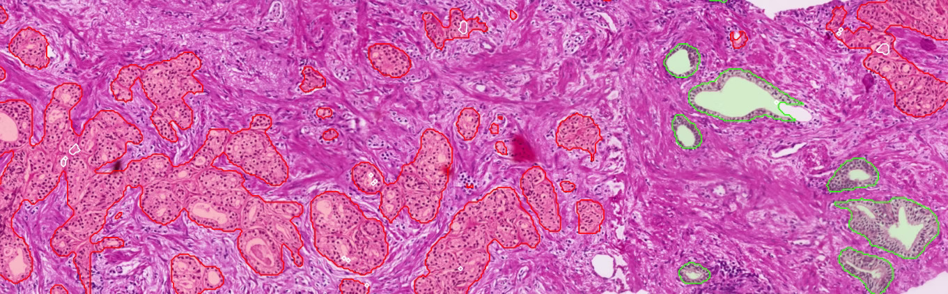 QAi Prostate